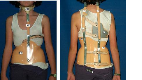 When a Teen with Scoliosis Won't Wear a Back Brace